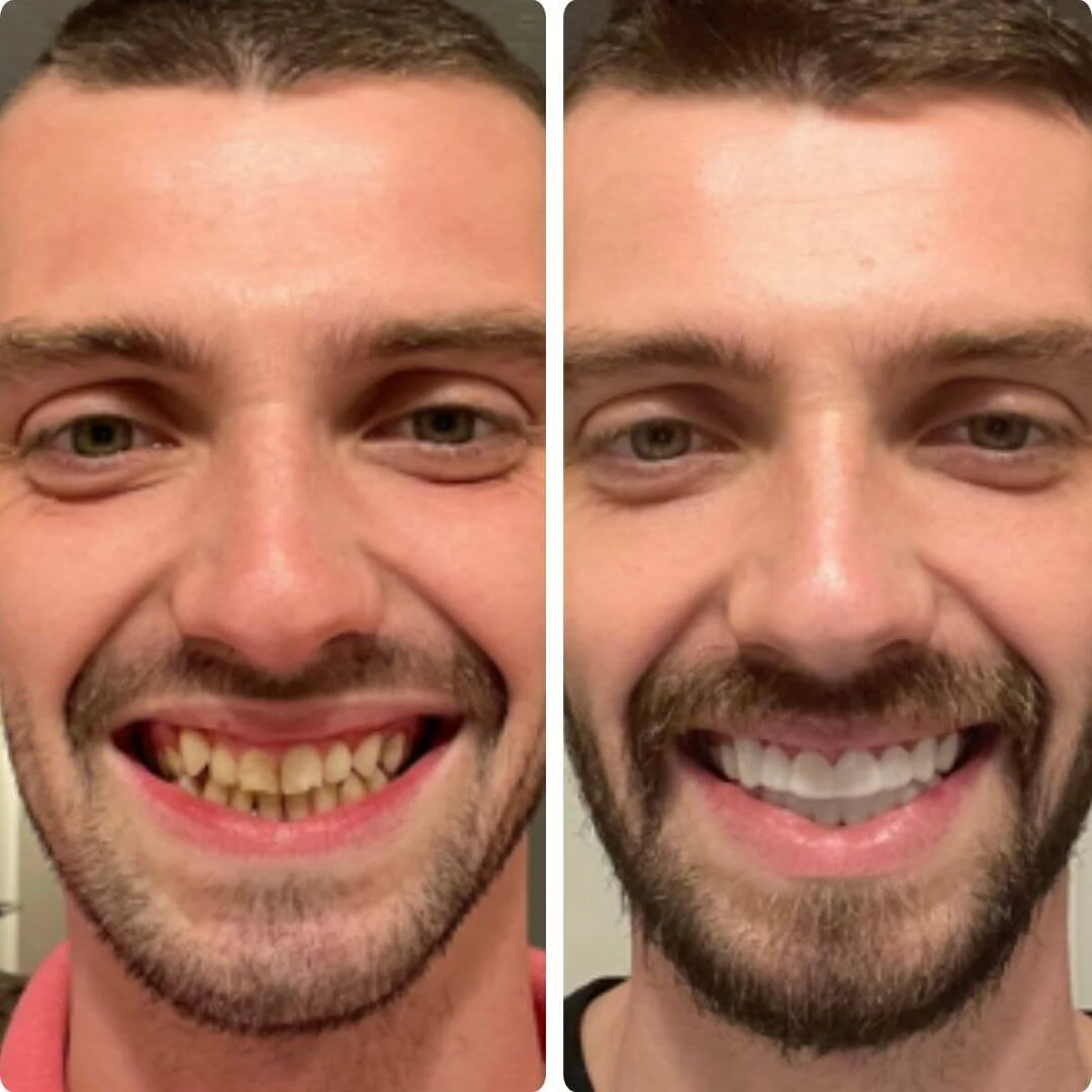 Who Is Pop On Veneers For
