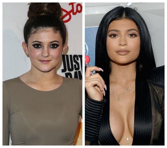 Kylie Jenner Before and After